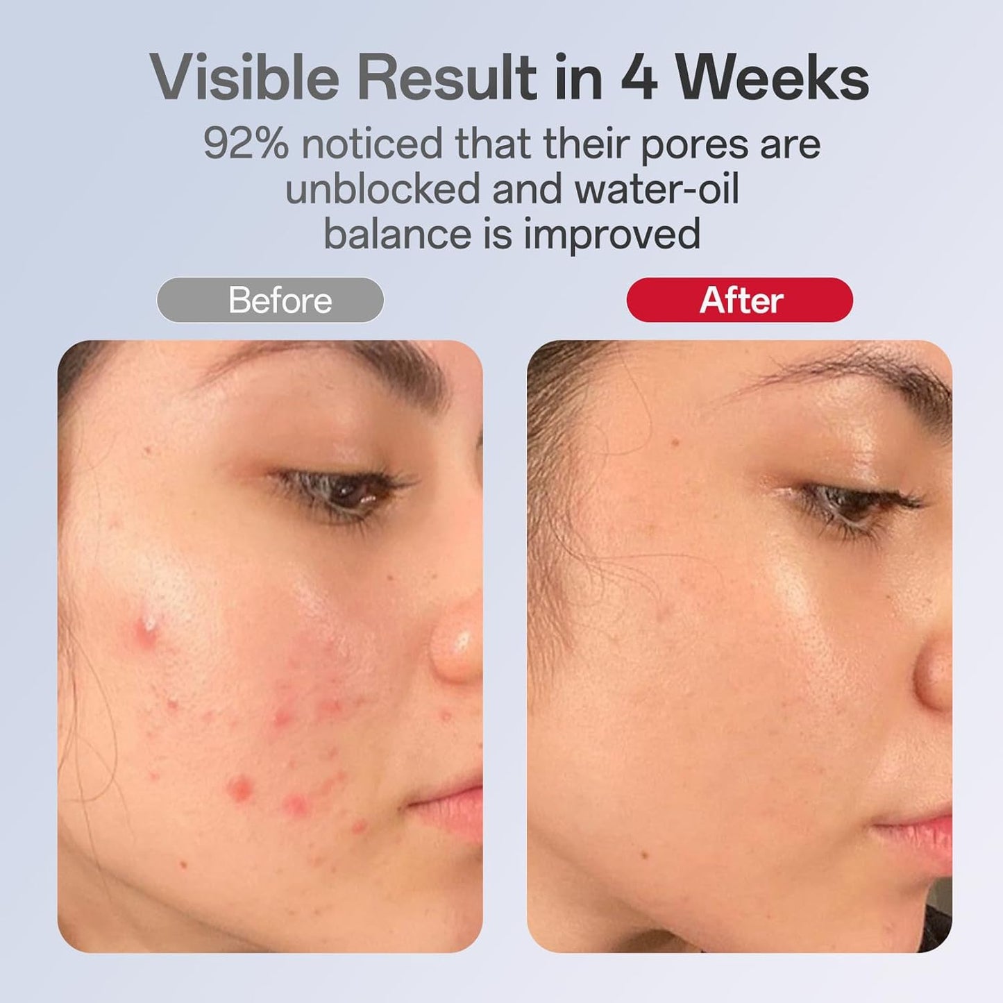 LED mask before and after photos showing reduced wrinkles fine lines 4 week results